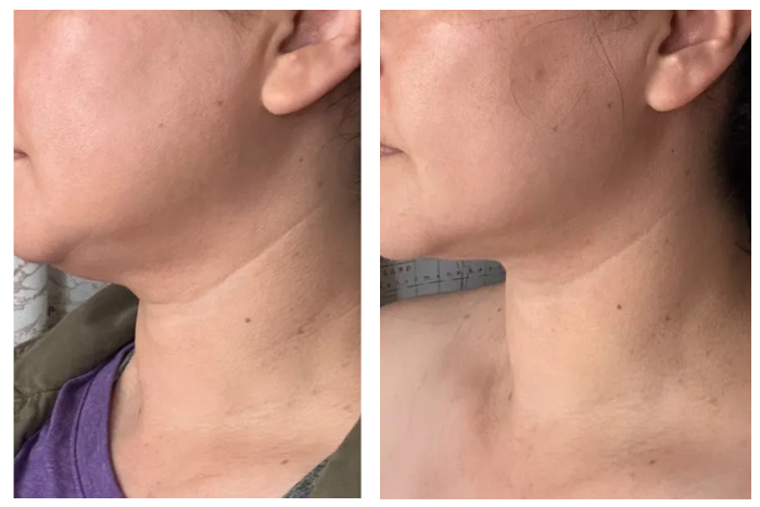 Before and after result